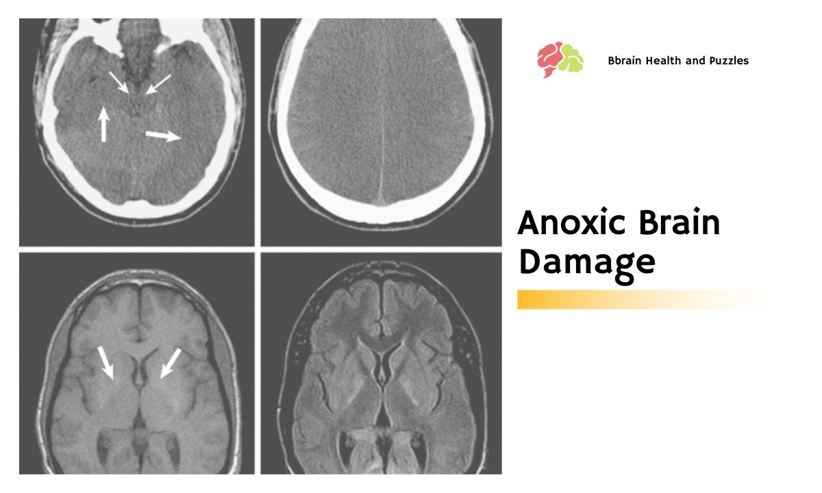 Anoxic Brain Damage