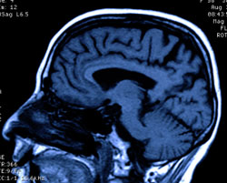 brain_ventricles_neurology