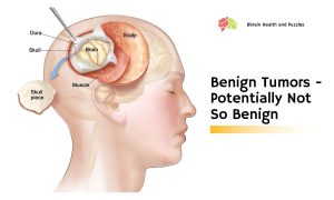 Benign Tumors - Potentially Not So Benign