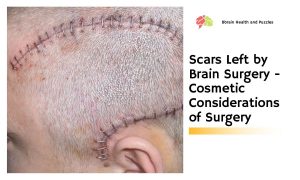 Scars Left by Brain Surgery - Cosmetic Considerations of Surgery