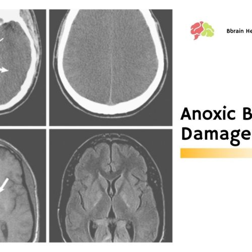 Anoxic Brain Damage