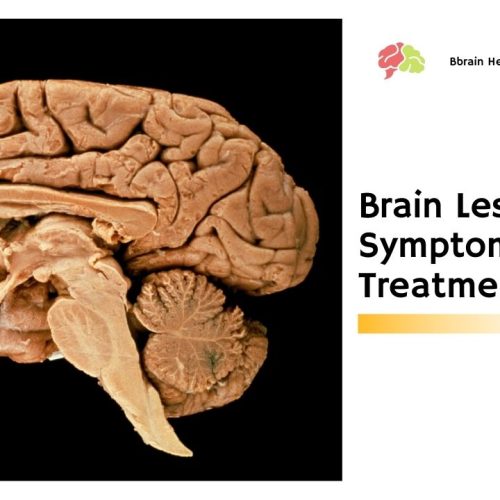 Brain Lesions – Symptoms And Treatment