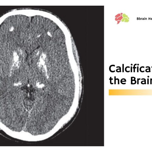 Calcification on the Brain