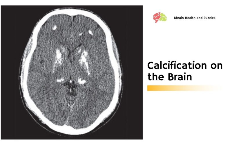 Calcification on the Brain