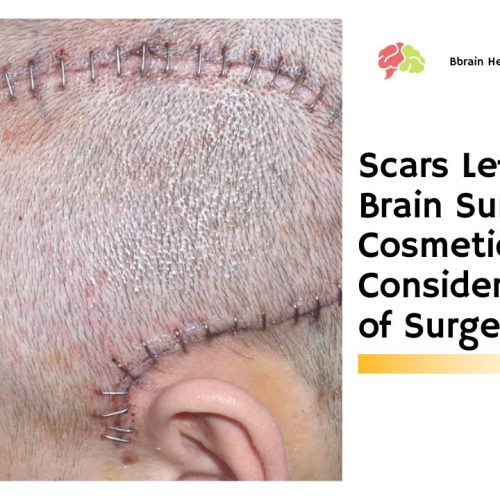 Scars Left by Brain Surgery – Cosmetic Considerations of Surgery