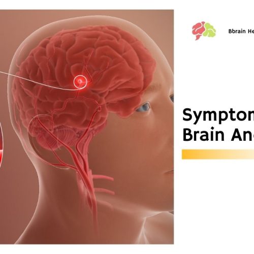 Symptoms of Brain Aneurysms